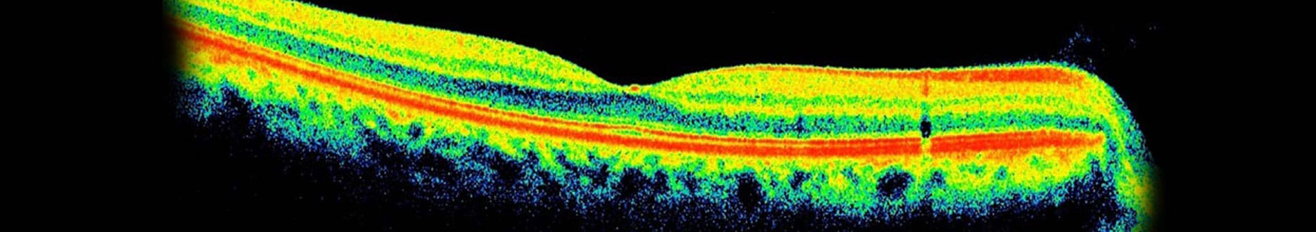 optical coherence tomography